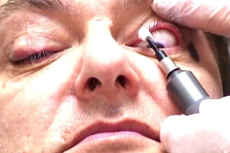 Demodex Infestation in Eyelashes Demodex in Eyelashes