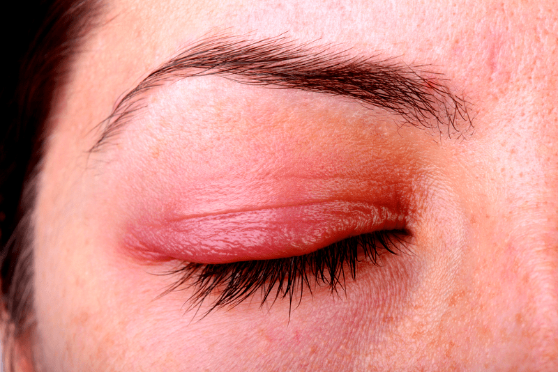 Is it Just a Common Eye Allergy, or is it Ocular Rosacea?